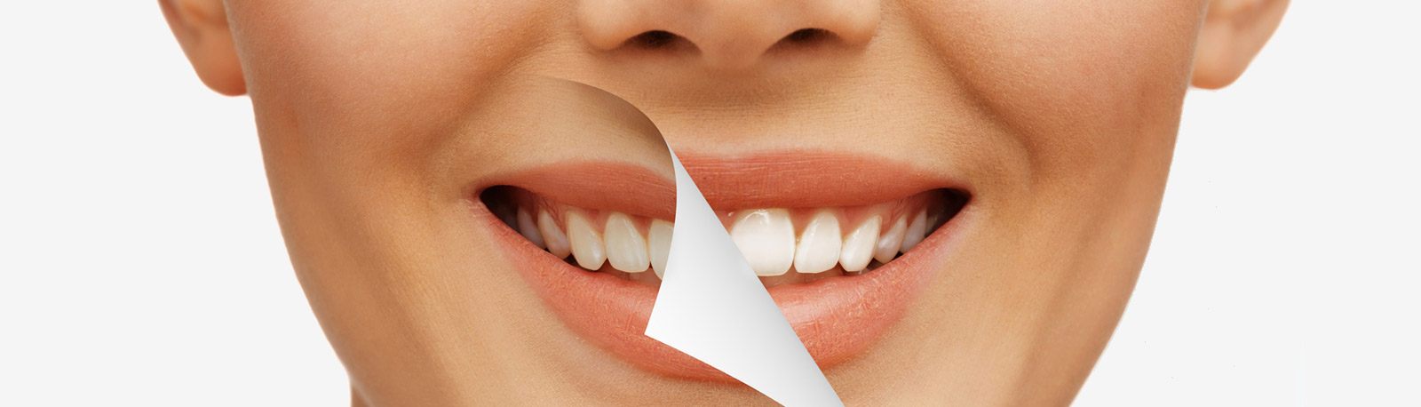 Stained Teeth Treatment in Dunedin FL - Whitening Solutions